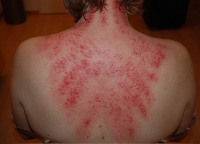 Gua Sha Behandlung